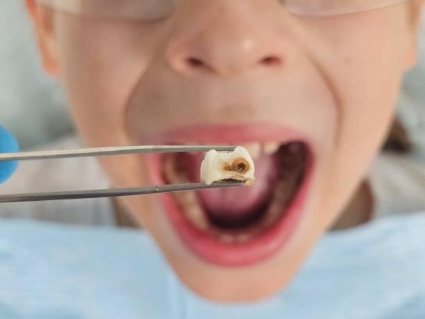 Best Dentist for Tooth Abscess  in Bement, IL